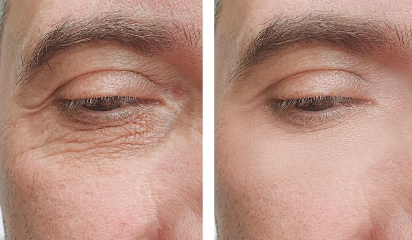 blefaroplastia